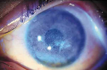 Imagen de un ojo con daño a la córnea. Se ve como si estuviese cubierto de una capa de color blanco lechoso, semi transparente.