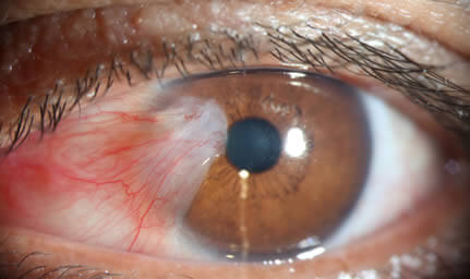 Fotografía de un ojo cubierto en parte por una capa blanca y con venas delgadas que está alcanzando la pupila.