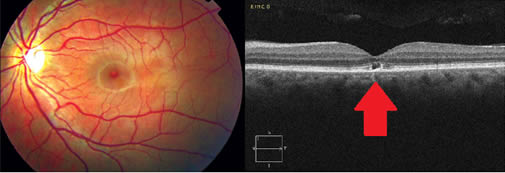 Se ve una fotografía de la retina hundida en un punto (señalado por una flecha roja en la imagen) 